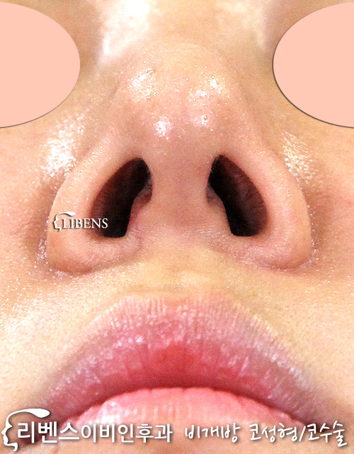 코끝 콧대 성형 수술 높이기 실리콘 2미리 비염 성형 s595